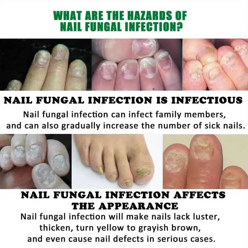 Ginger Nail Care Liquid Onychomycosis Fungus Repair Hand and Foot Nail Care