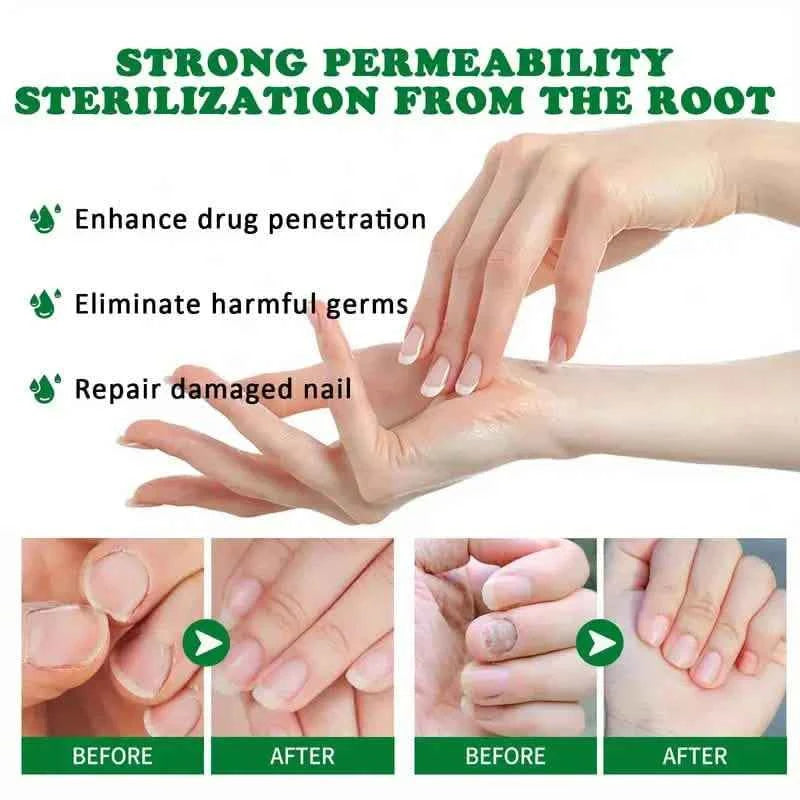 Ginger Nail Care Liquid Onychomycosis Fungus Repair Hand and Foot Nail Care